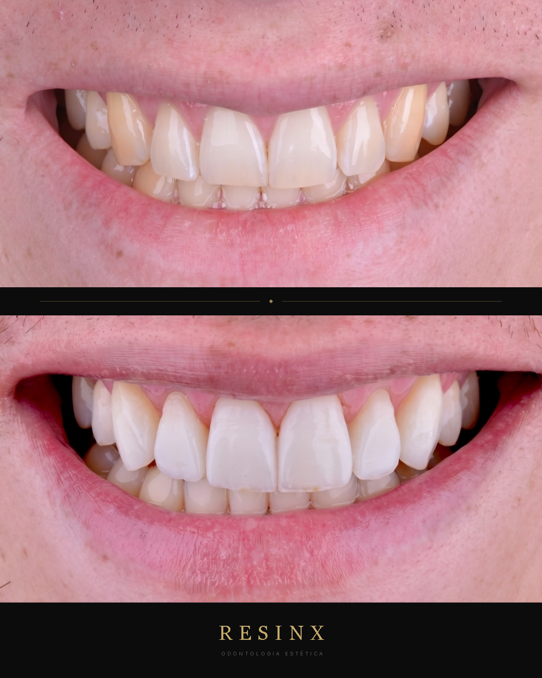 Antes e depois — caso clínico 11 RESINX