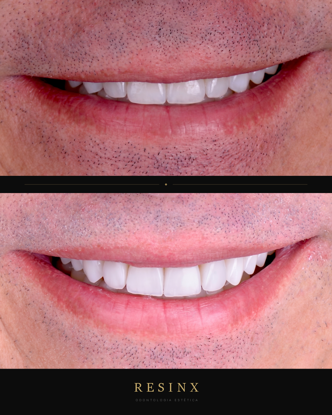 Antes e depois — caso clínico 8 RESINX