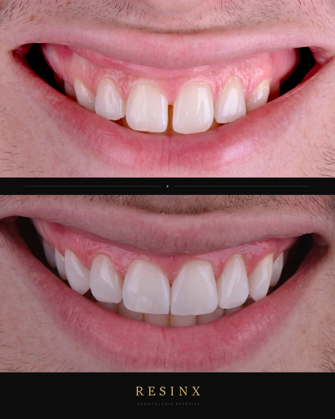 Antes e depois — caso clínico 12 RESINX