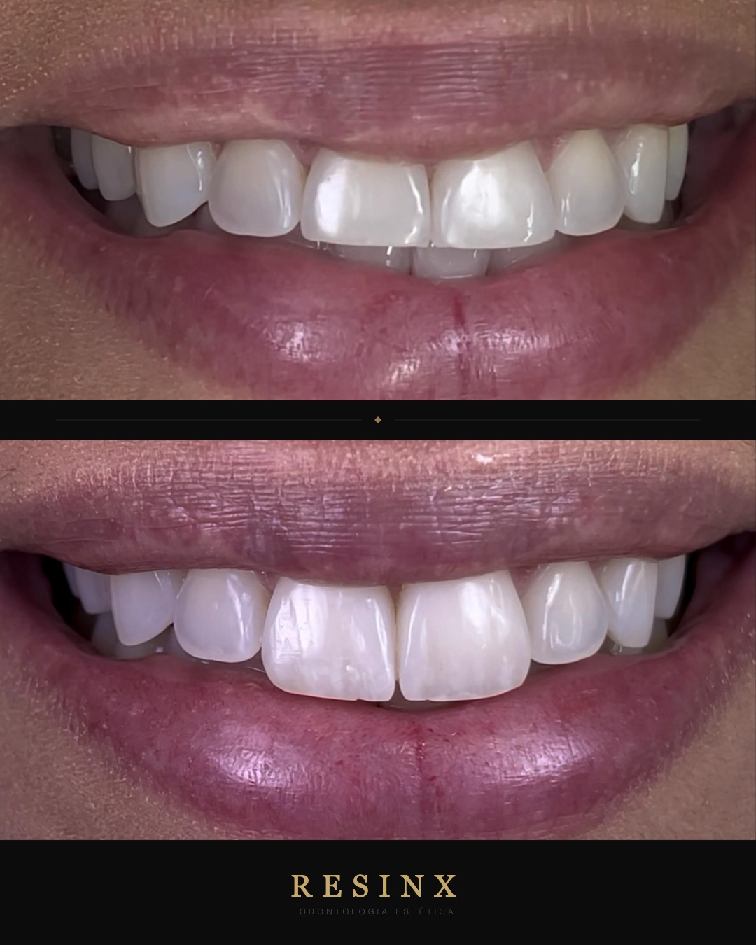 Antes e depois — caso clínico 6 RESINX