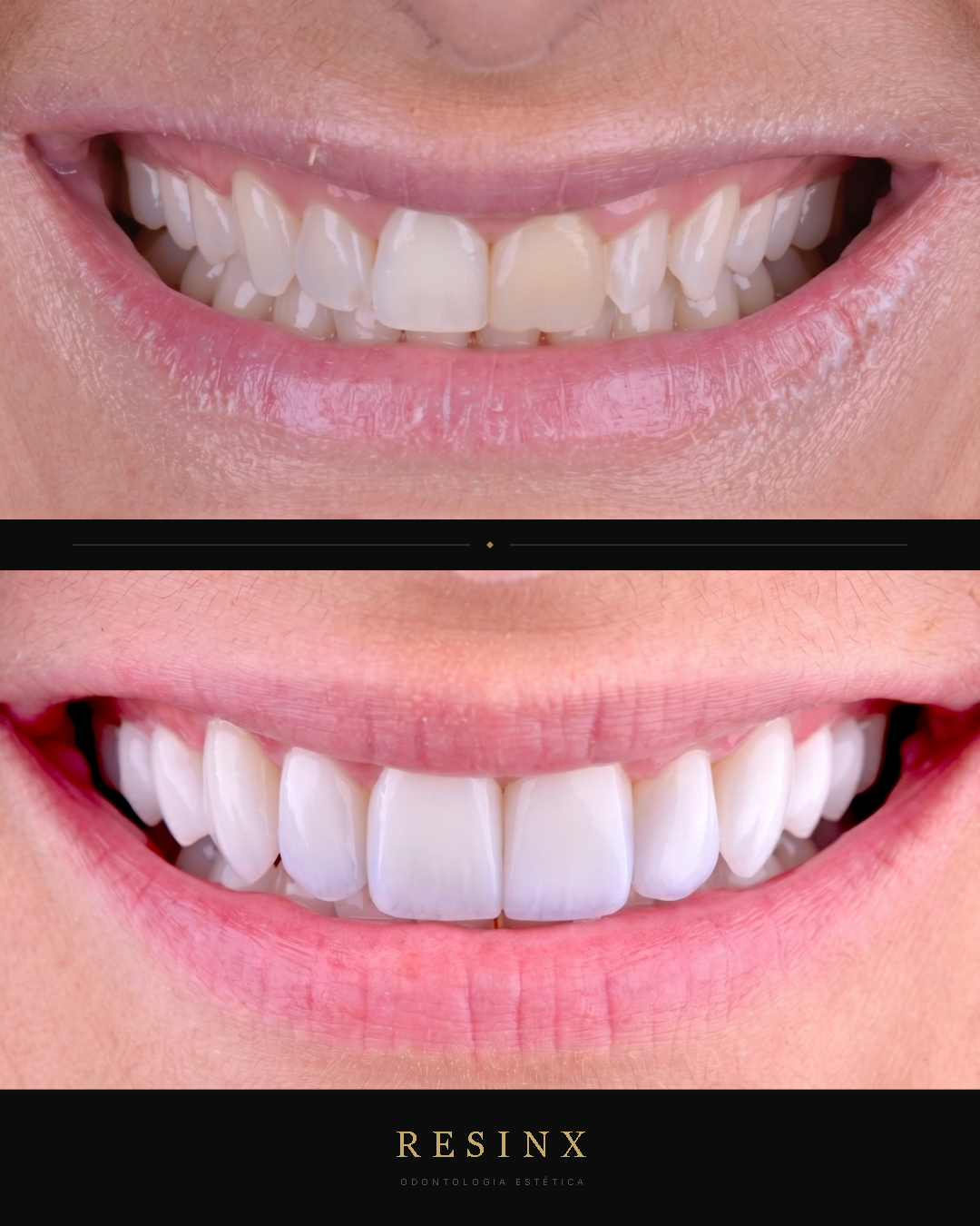Antes e depois — caso clínico 10 RESINX
