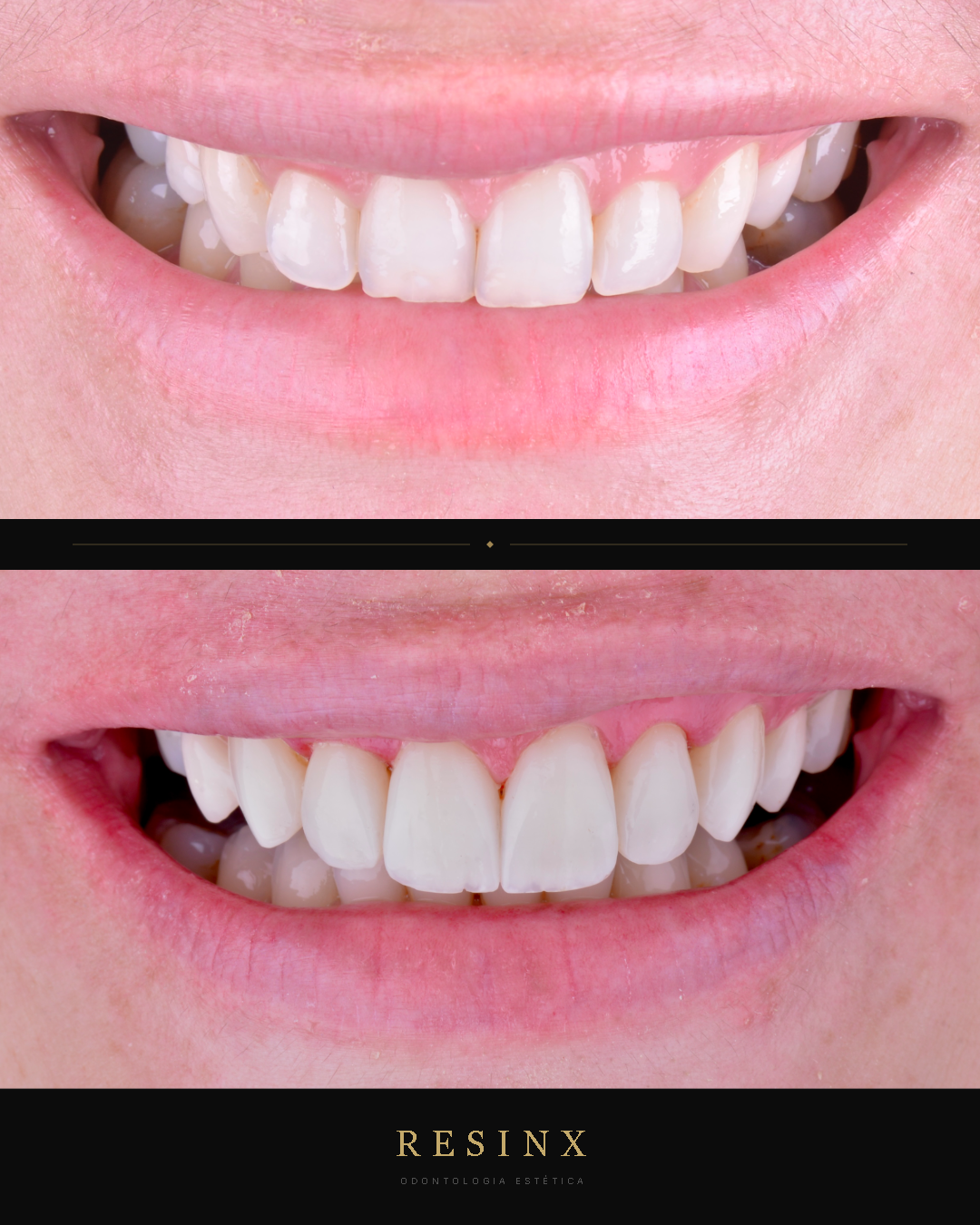 Antes e depois — caso clínico 7 RESINX