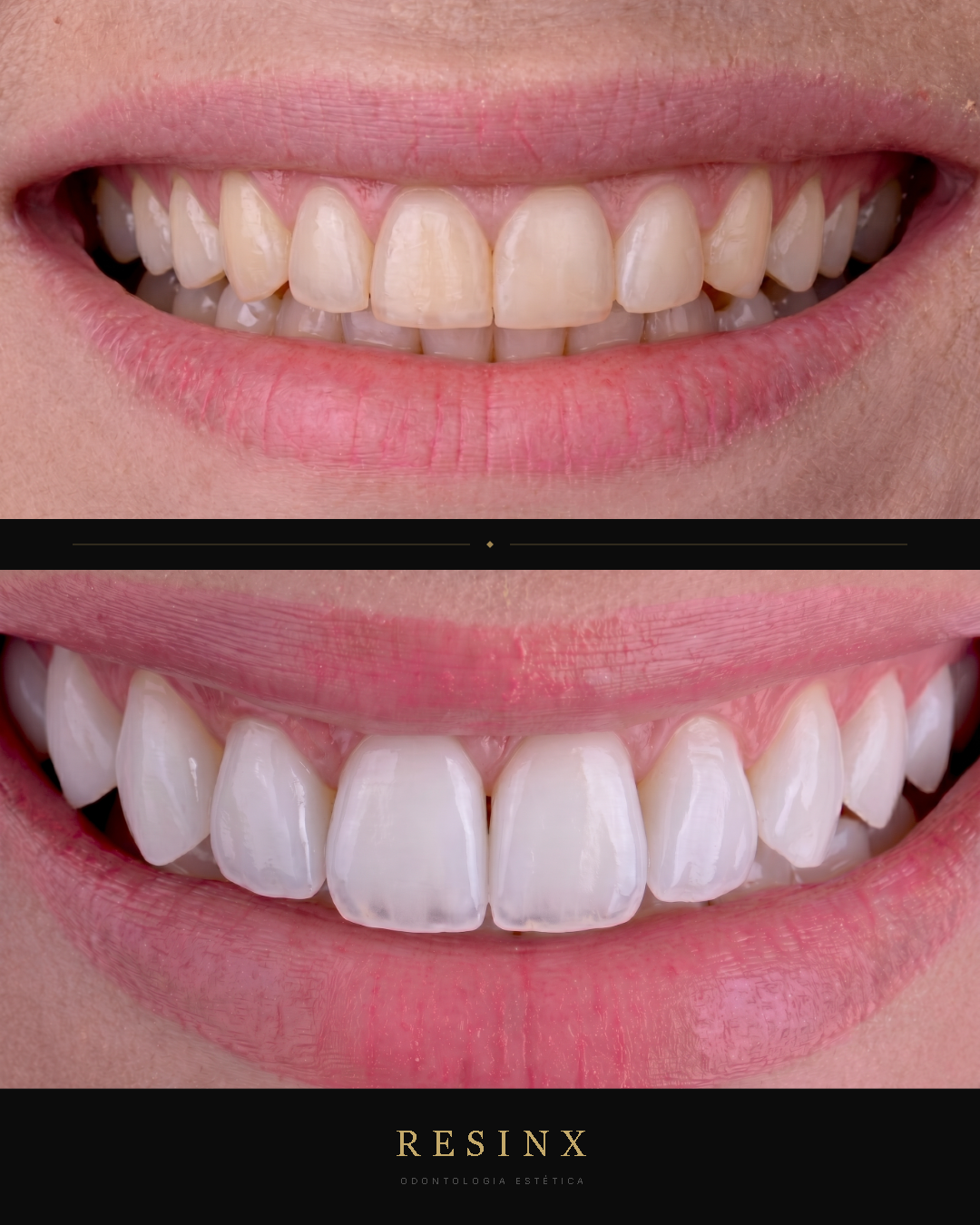 Antes e depois — caso clínico 9 RESINX