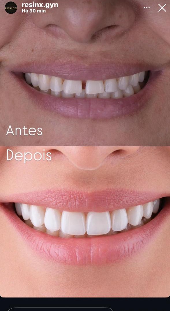 Antes e depois real — paciente da RESINX